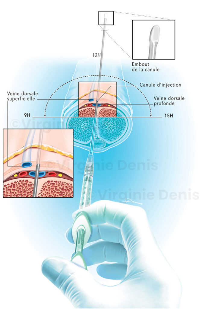 Illustration médicale injection acide hyaluronique