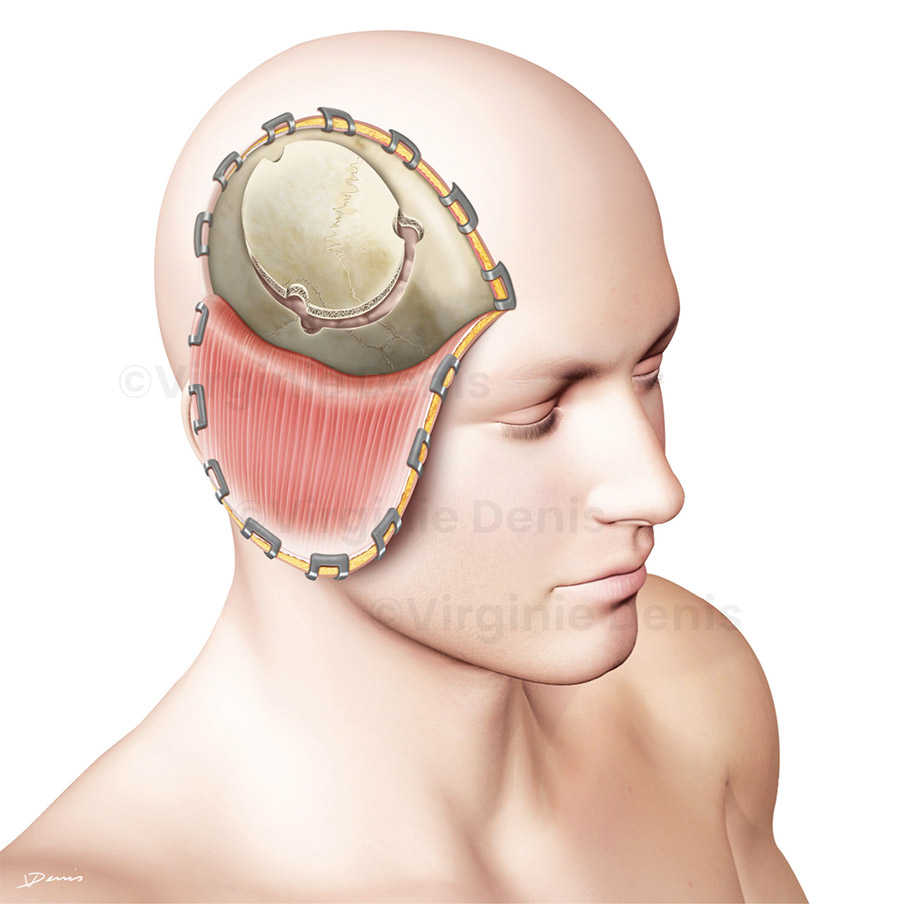 Illustration médicale chirurgie Craniotomie