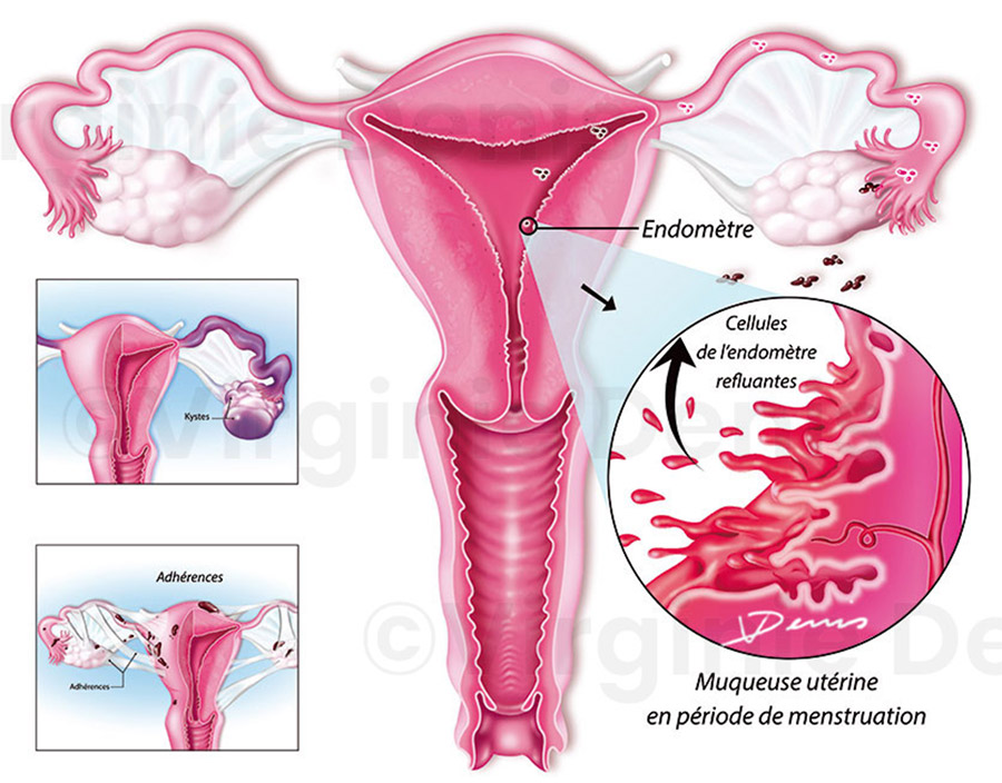 Illustration médicale Endométriose