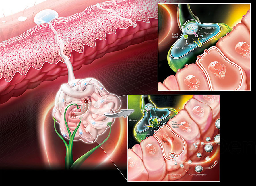 Illustration médicale Hyperidrose