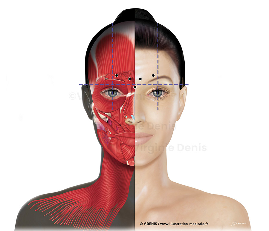 Illustration médicale Points d'injection toxine botulique chirurgie esthétique