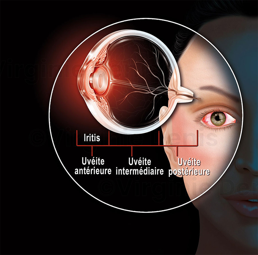 illustration médicale Uvéite