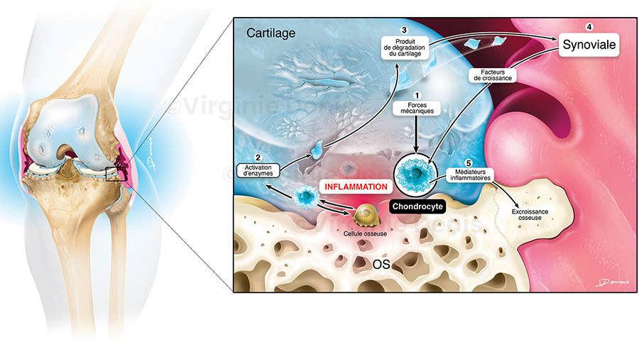 illustration médicale Arthrose du genou