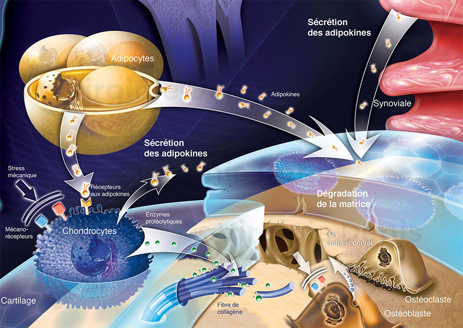 illustration médicale Arthrose