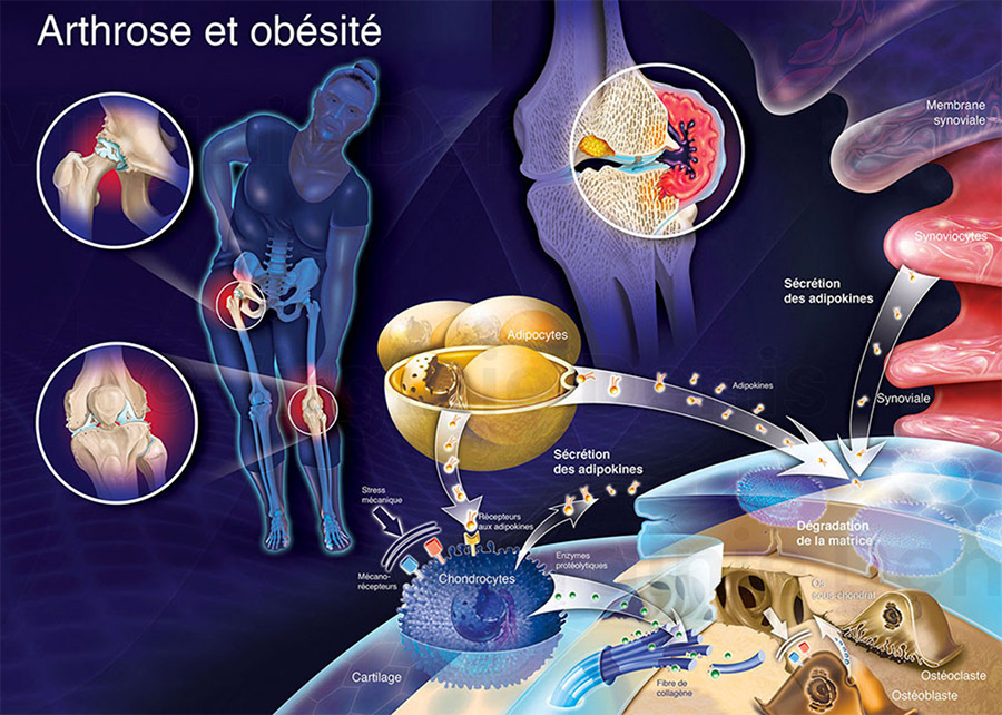 illustration médicale Arthrose