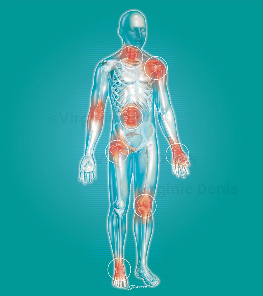 Illustration médicale articulations douloureuses