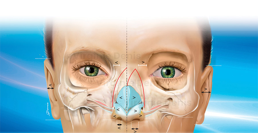 Illustration médicale Chirurgie esthétique - Asymétrie faciale