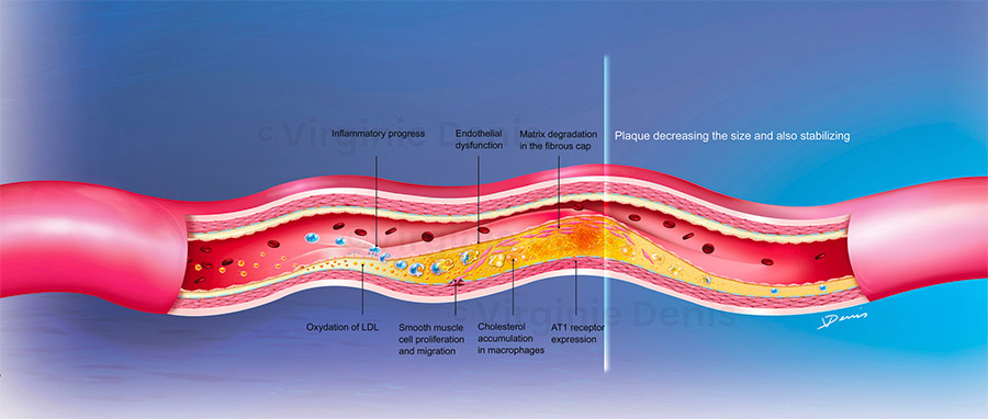 illustration médicale plaque athérome - athérosclérose