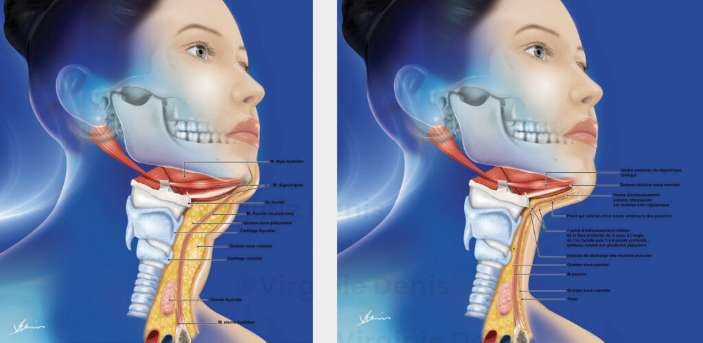 illustration médicale Lifting cervico mentonnier