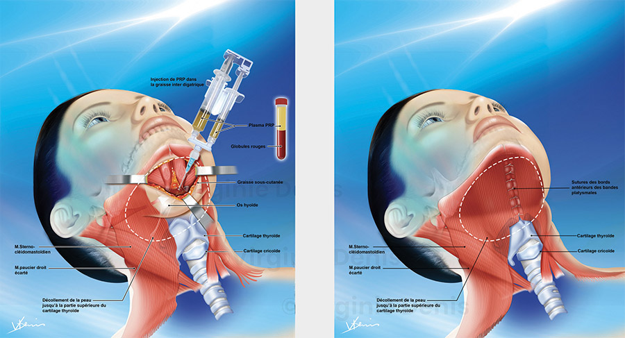 illustration médicale Lifting cervico mentonnier