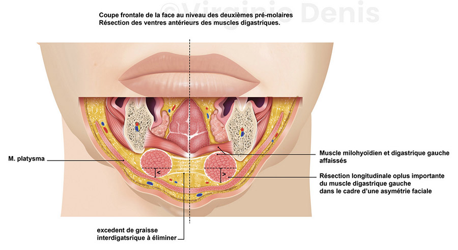 illustration médicale Lifting cervico mentonnier