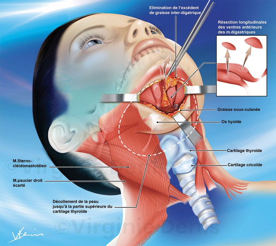 illustration médicale Lifting cervico mentonnier