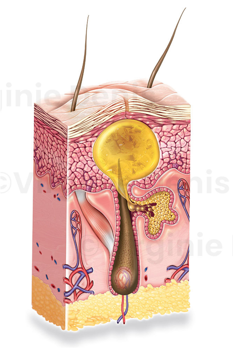 illustration médicale comédon coupe de peau