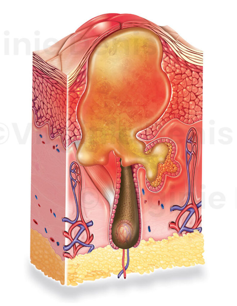 illustration médicale comédon coupe de peau