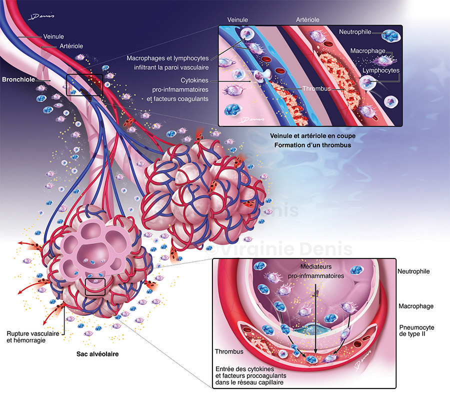 Illustration médicale Covid 19