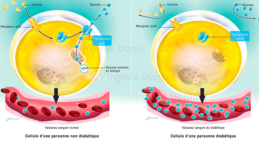 illustration médicale diabète