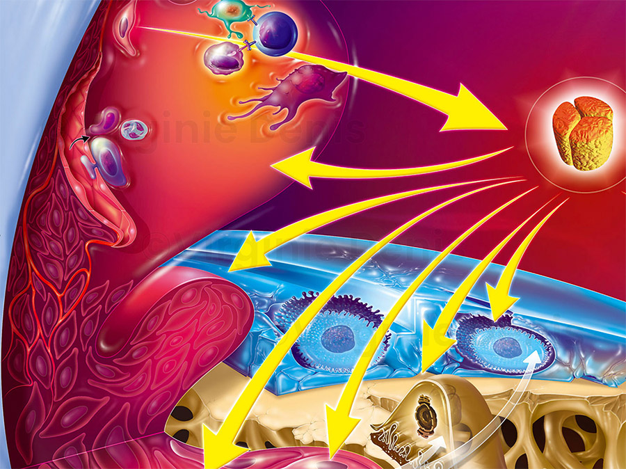 illustration médicale Polyarthrite-rhumatoïde