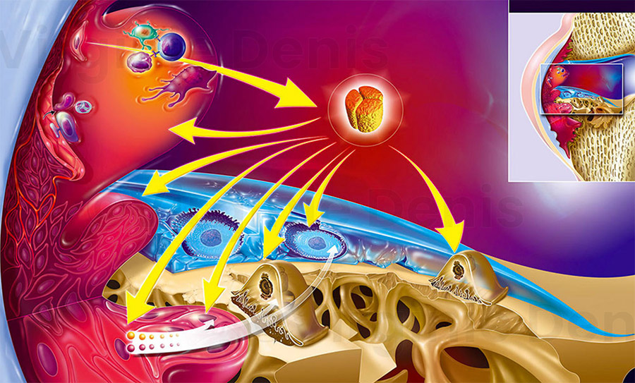 illustration médicale Polyarthrite-rhumatoïde