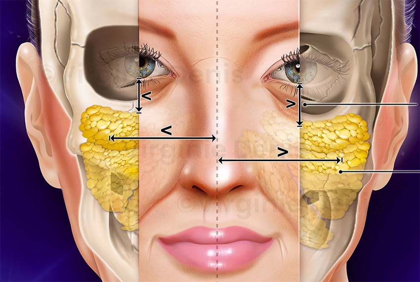 Illustration médicale : lifting du visage