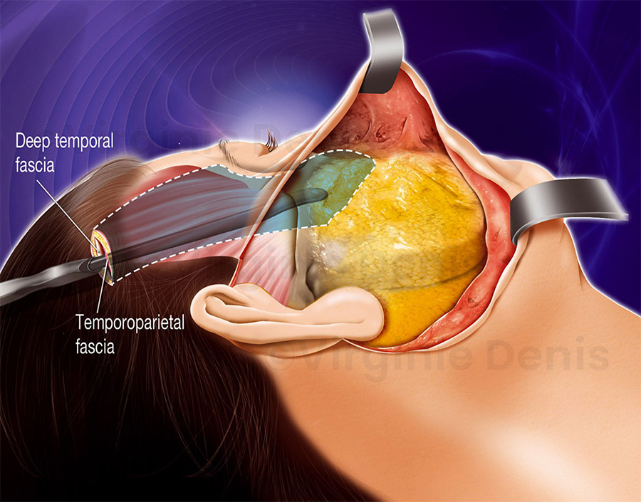 illustration médicale lifting visage chirurgie esthétique