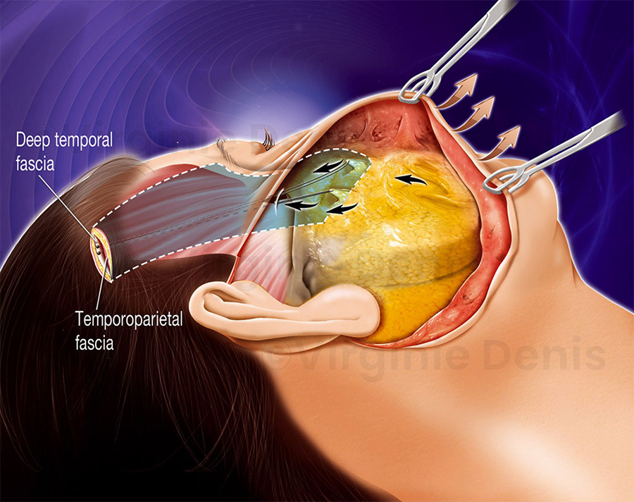 illustration médicale lifting visage chirurgie esthétique