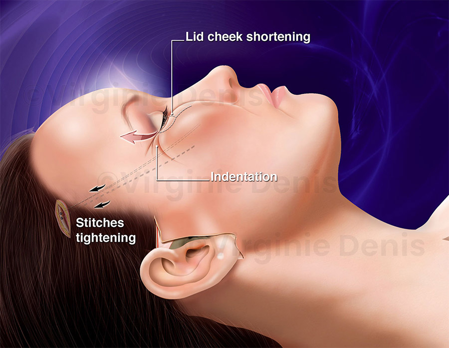 illustration médicale lifting visage chirurgie esthétique