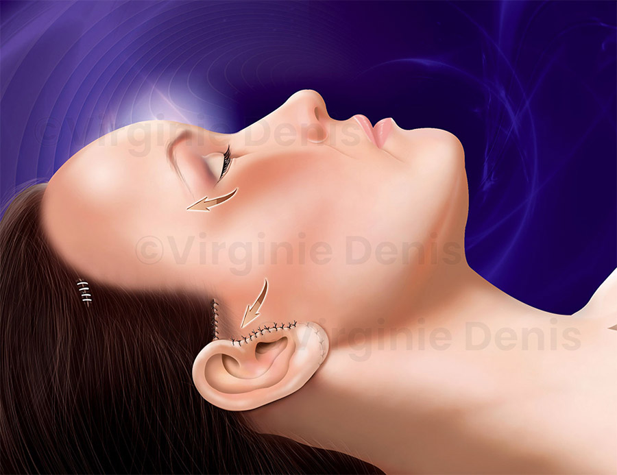 illustration médicale lifting visage chirurgie esthétique