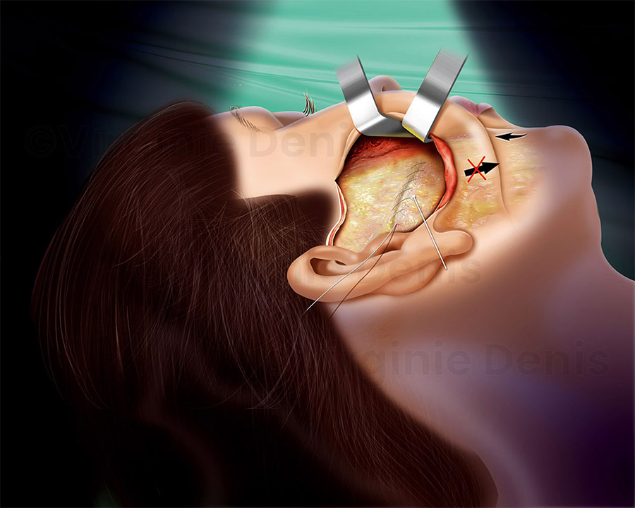 illustration médicale lifting visage chirurgie esthétique