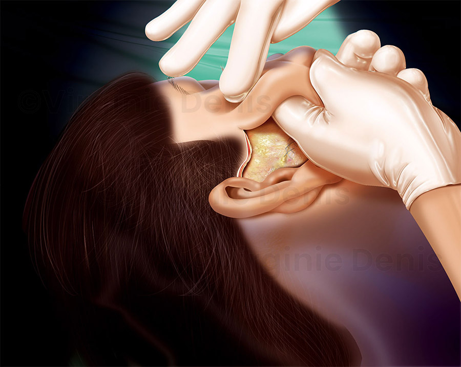 illustration médicale lifting visage chirurgie esthétique