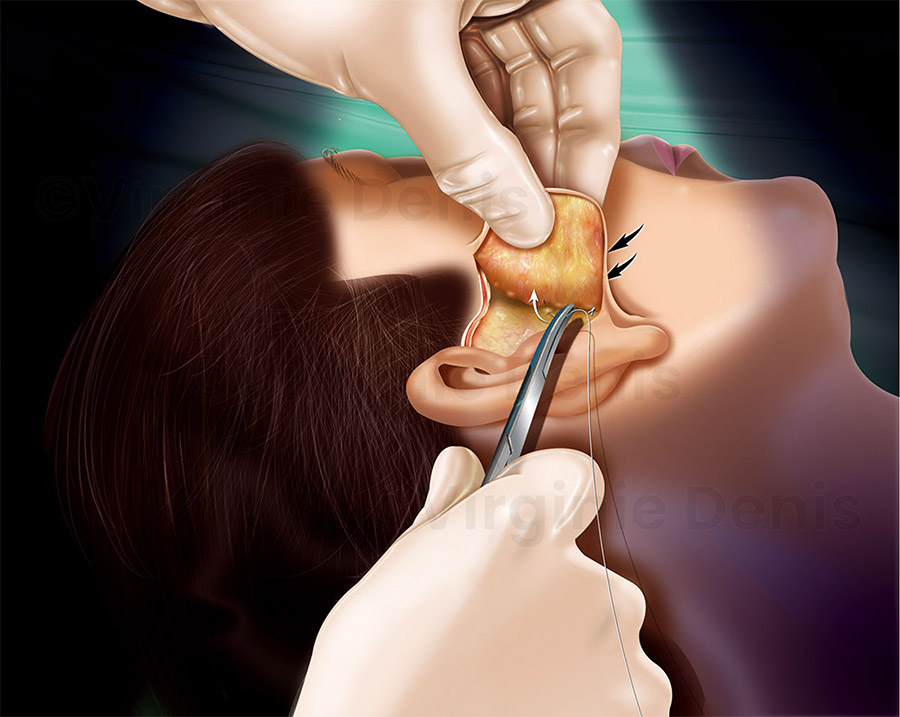 illustration médicale lifting visage chirurgie esthétique