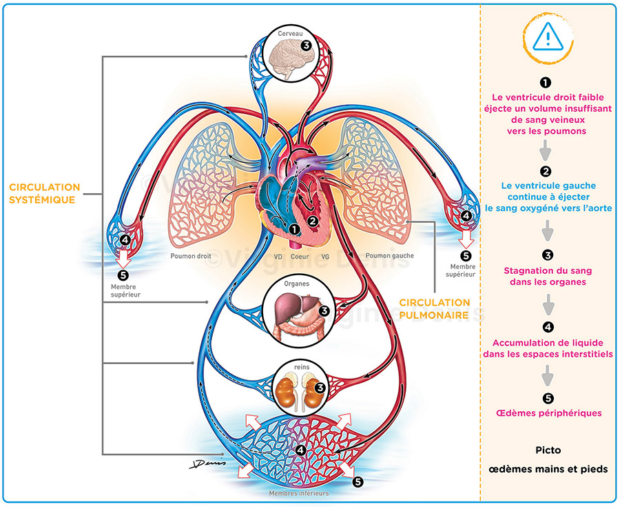 illustration médicale insuffisance cardiaque