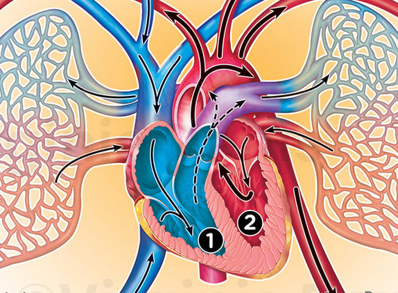 illustration médicale insuffisance cardiaque