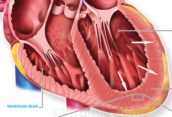 illustration médicale insuffisance cardiaque