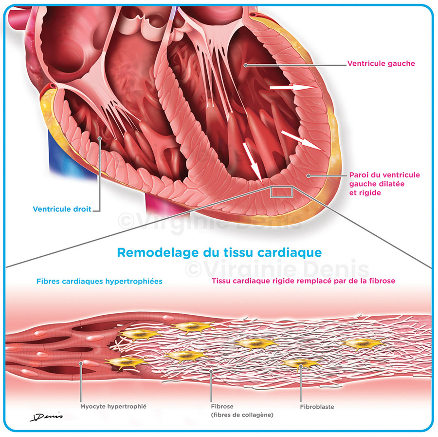 illustration médicale insuffisance cardiaque