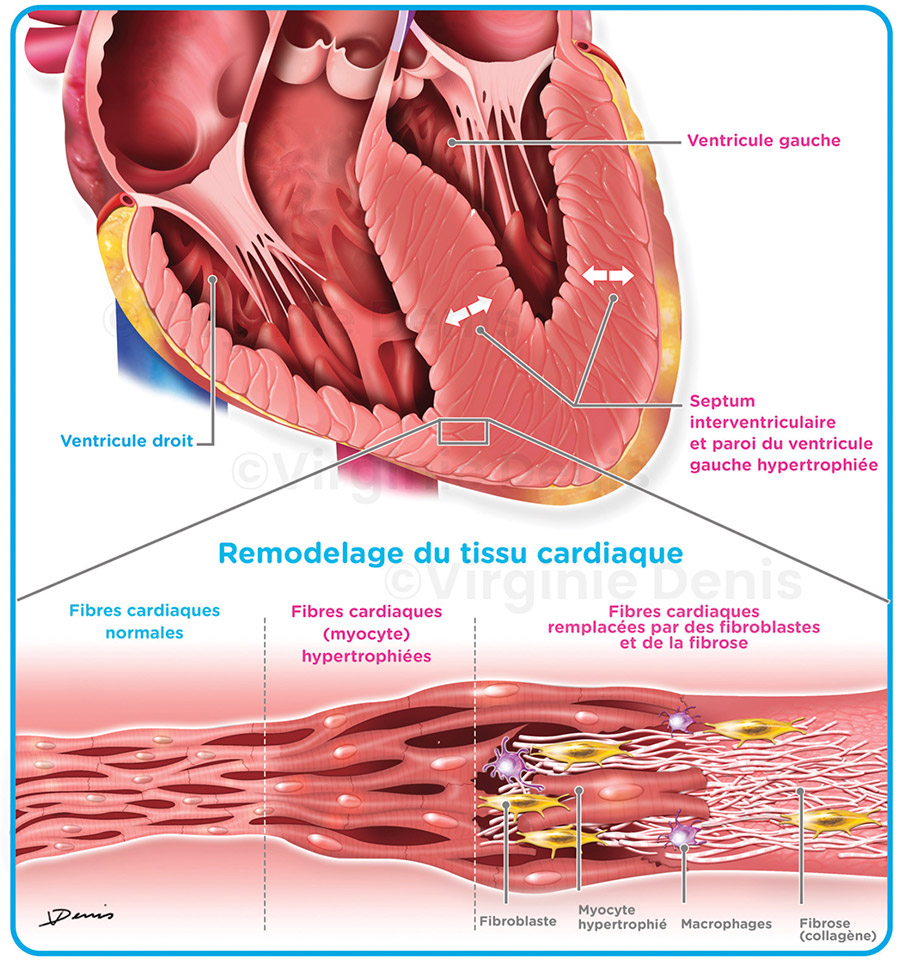 illustration médicale insuffisance cardiaque