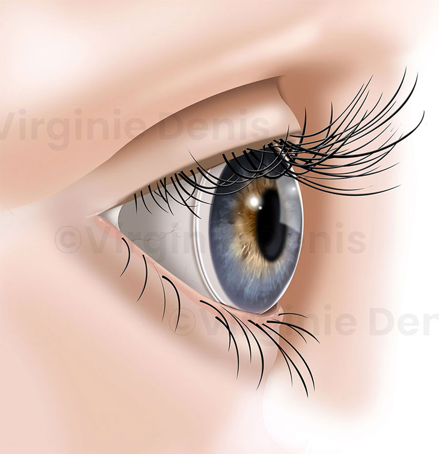 Illustration lentille de contact