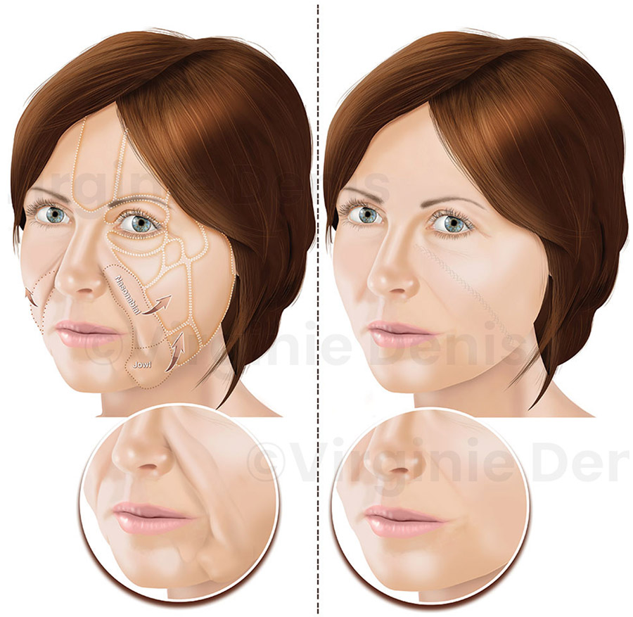 illustration médicale mini lifting chirurgie esthétique