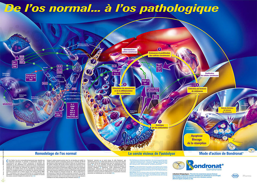 illustration médicale maladie osseuse