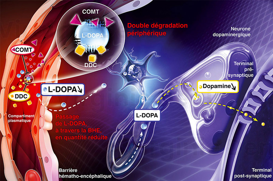 Illustration médicale maladie de Parkinson