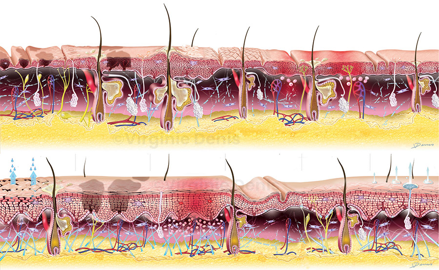 Illustration médicale pathologies de la peau