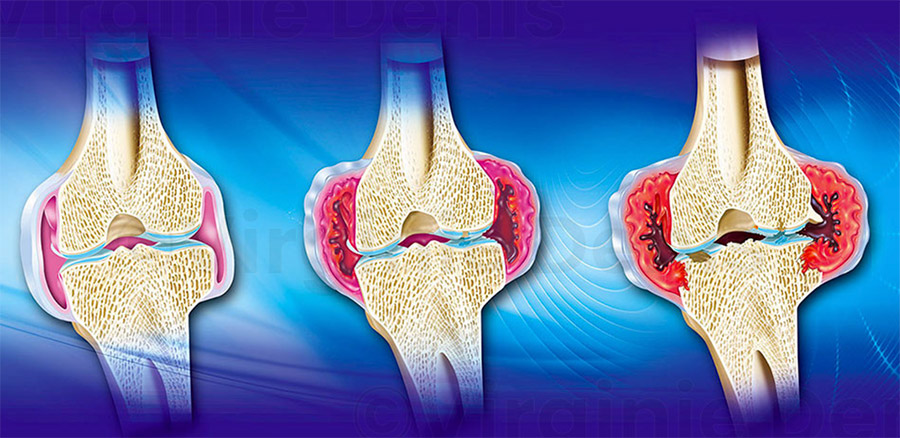 illustration médicale Polyarthrite Rhumatoïde