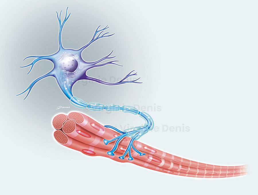 illustration médicale SMA - Amyotrophie spinal